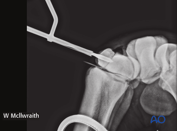 arthroscopic screw fixation