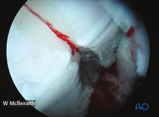 arthroscopic screw fixation