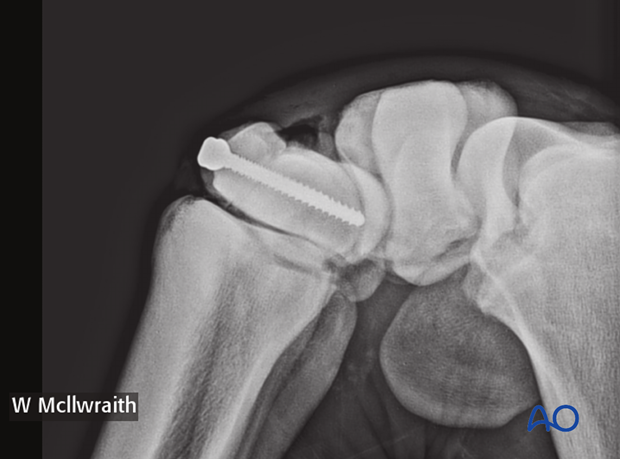 arthroscopic screw fixation