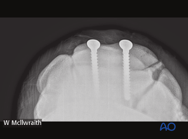 arthroscopic screw fixation