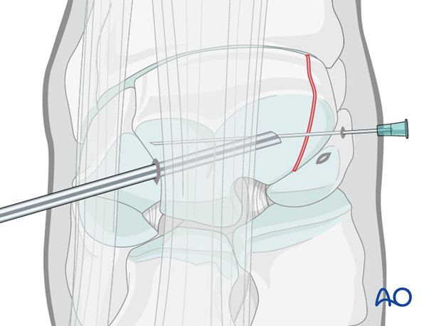 arthroscopic screw fixation
