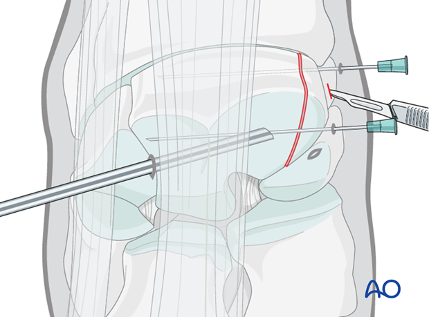 arthroscopic screw fixation