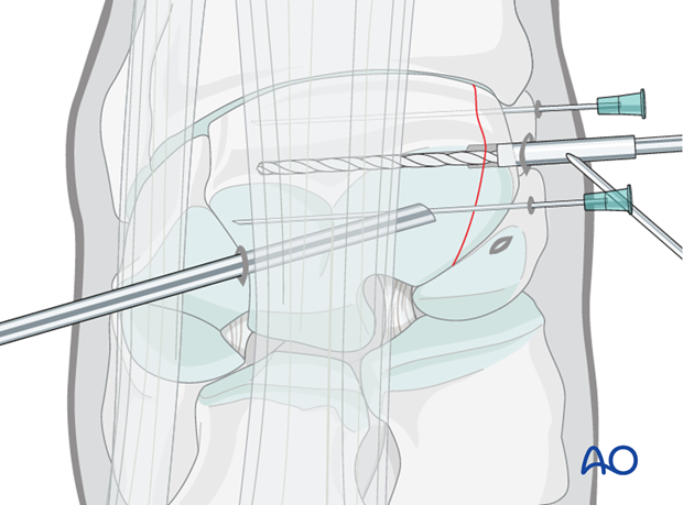 arthroscopic screw fixation