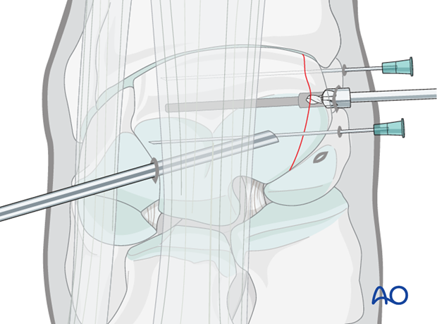 arthroscopic screw fixation