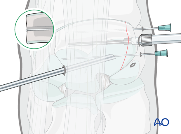 arthroscopic screw fixation