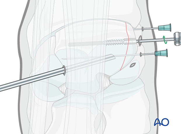 arthroscopic screw fixation