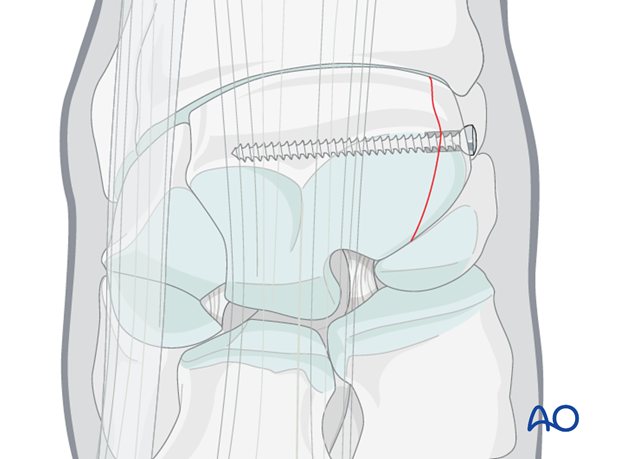 arthroscopic screw fixation