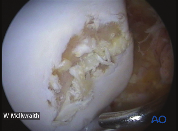 arthroscopic screw fixation