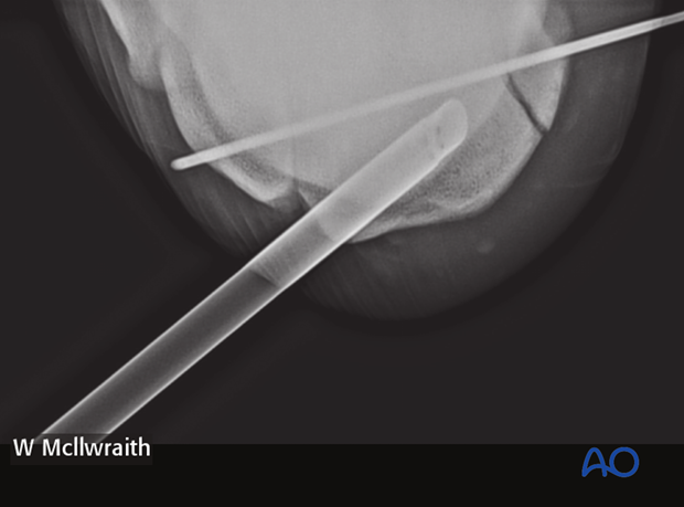 arthroscopic screw fixation