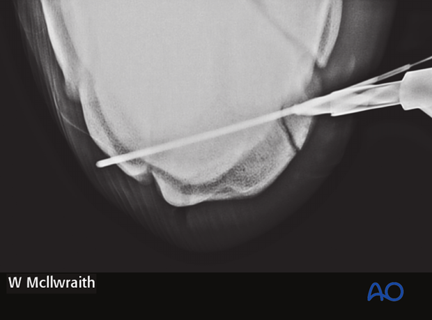 arthroscopic screw fixation