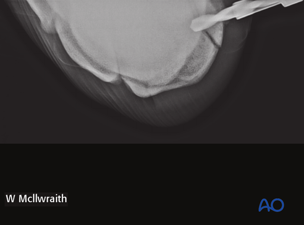 arthroscopic screw fixation