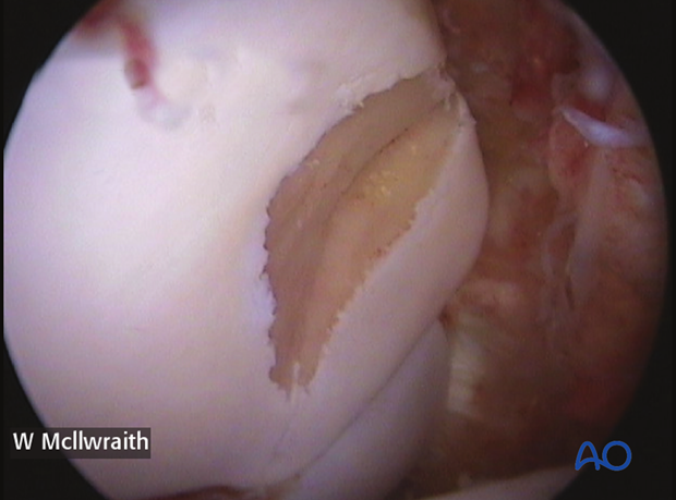 arthroscopic screw fixation