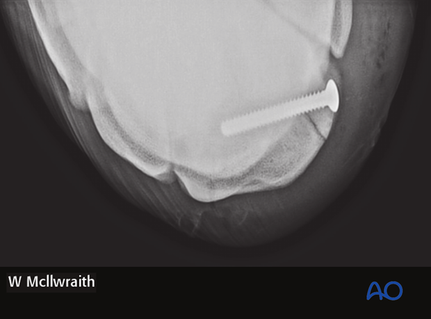 arthroscopic screw fixation