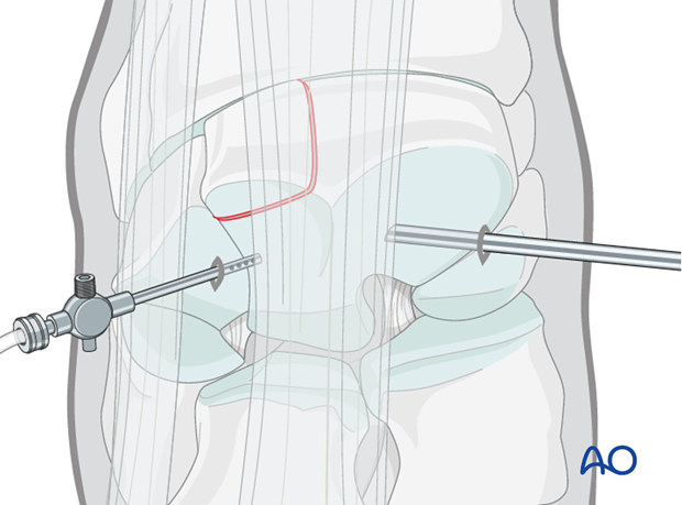 H70_P430_i115 arthroscopic screw fixation