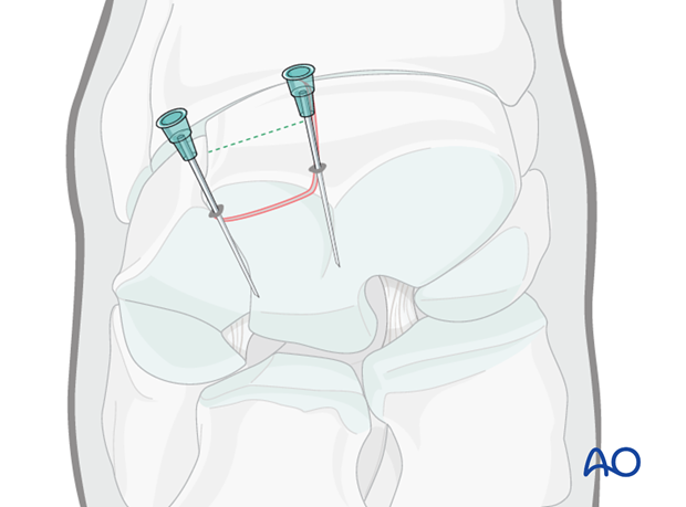 H70_P430_i330 arthroscopic screw fixation