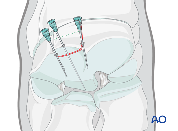 H70_P430_i340 arthroscopic screw fixation