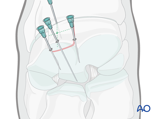 H70_P430_i350 arthroscopic screw fixation