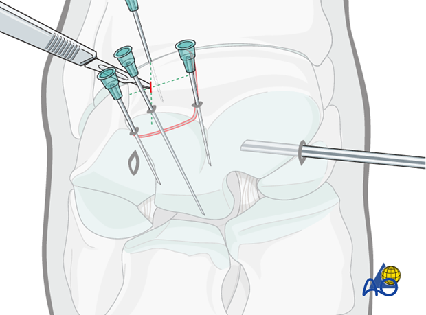 H70_P430_i450 arthroscopic screw fixation