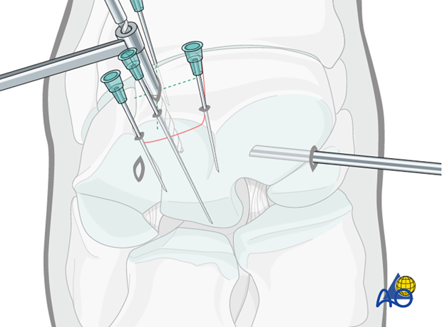 H70_P430_i460 arthroscopic screw fixation