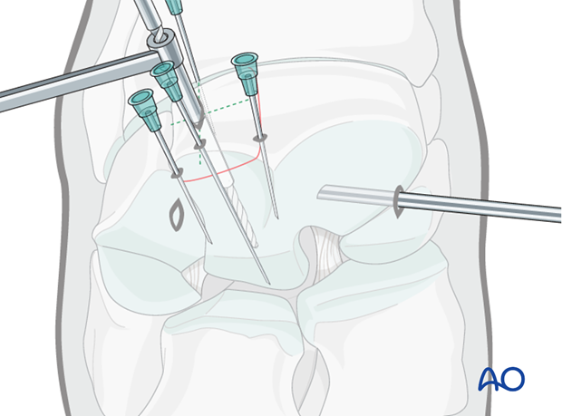 H70_P430_i470 arthroscopic screw fixation