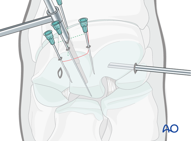 H70_P430_i480 arthroscopic screw fixation