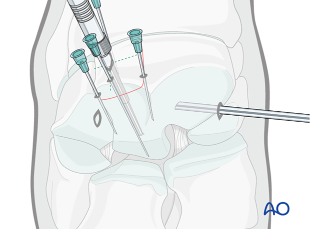 H70_P430_i500 arthroscopic screw fixation