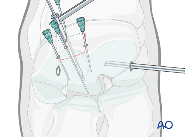 H70_P430_i510 arthroscopic screw fixation