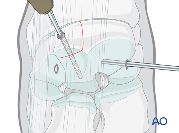 H70_P430_i890 arthroscopic screw fixation