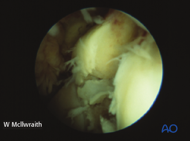H70_P430_p010 arthroscopic screw fixation