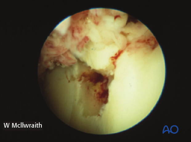 H70_P430_p020 arthroscopic screw fixation