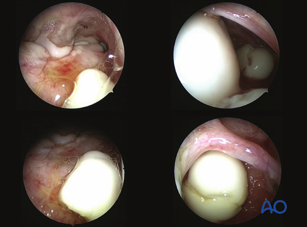Trochlear ridge fractures of the talus - resection