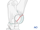 Trochlear ridge fractures of the talus - screw fixation