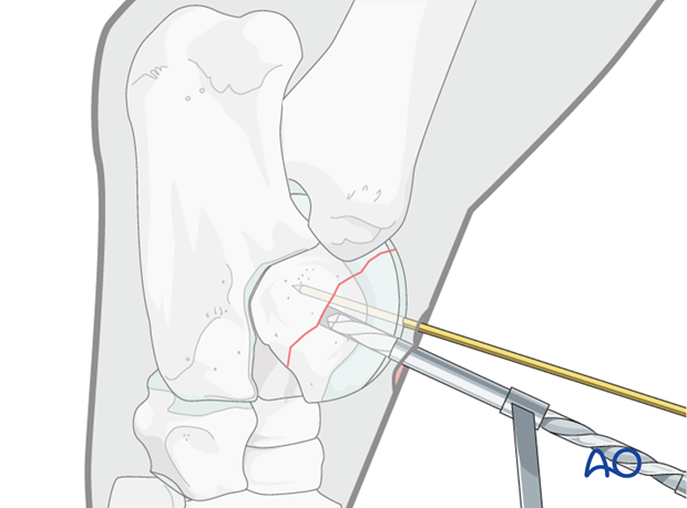 H80_C110_i130 Trochlear ridge fractures of the talus - screw fixation