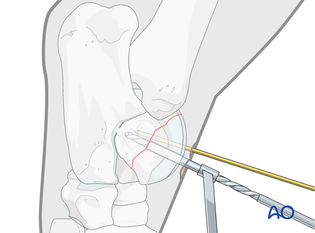 H80_C110_i140 Trochlear ridge fractures of the talus - screw fixation