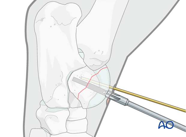 H80_C110_i150 Trochlear ridge fractures of the talus - screw fixation