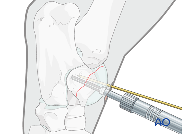 H80_C110_i160 Trochlear ridge fractures of the talus - screw fixation