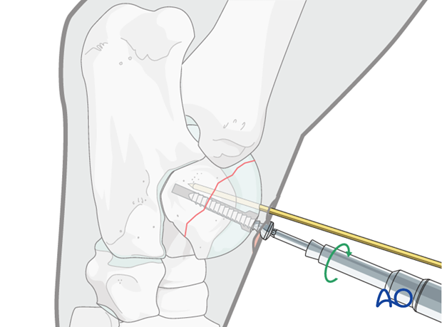 H80_C110_i180 Trochlear ridge fractures of the talus - screw fixation
