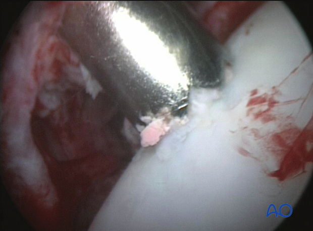 H80_C110_x500 Trochlear ridge fracture of the talus - screw fixation
