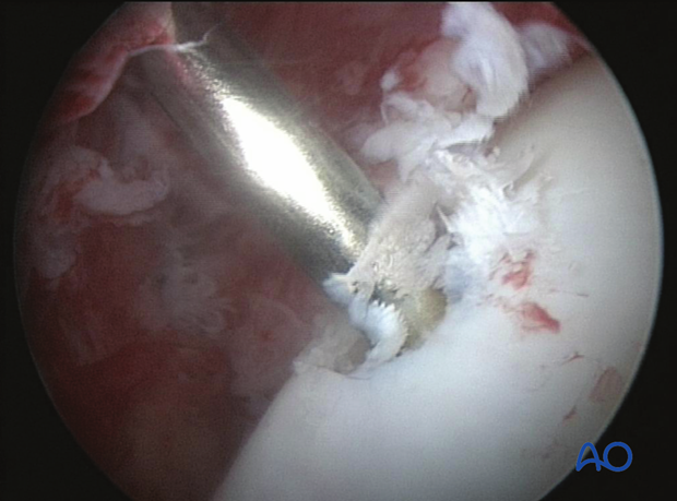 H80_C110_x600 Trochlear ridge fracture of the talus - screw fixation