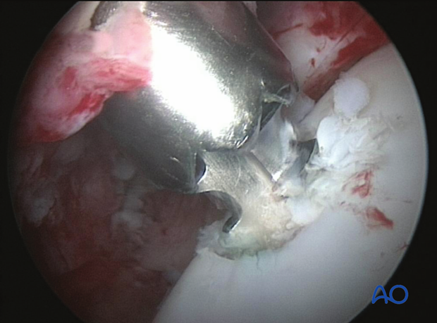 H80_C110_x700 Trochlear ridge fracture of the talus - screw fixation