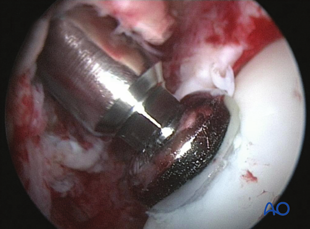 H80_C110_x800 Trochlear ridge fracture of the talus - screw fixation