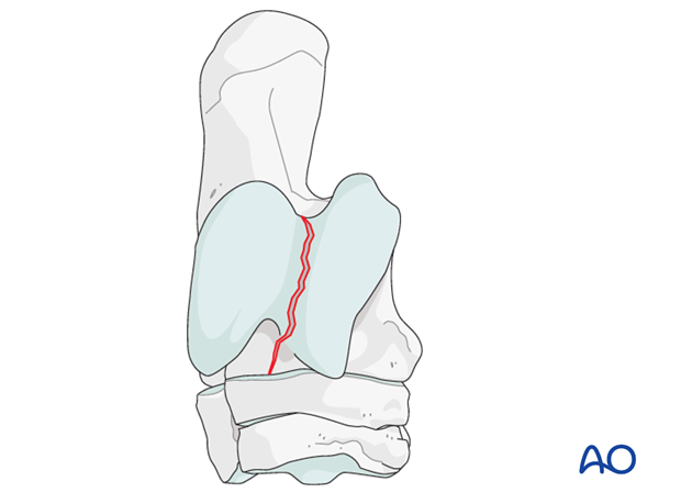 Sagittal fractures of the talus
