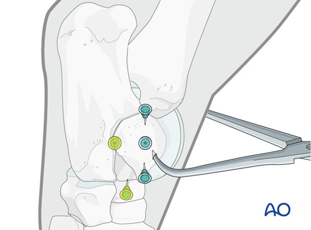H80_C130_i130 Complete sagittal fractures of the talus - screw fixation