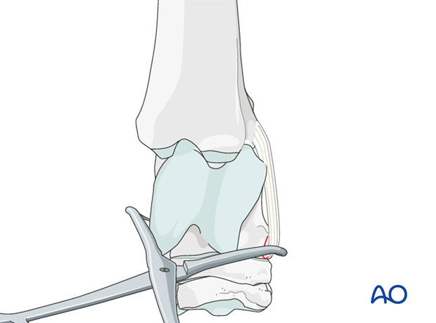 H80_C140_i110 Talus - fractures of the attachment of the collateral ligaments