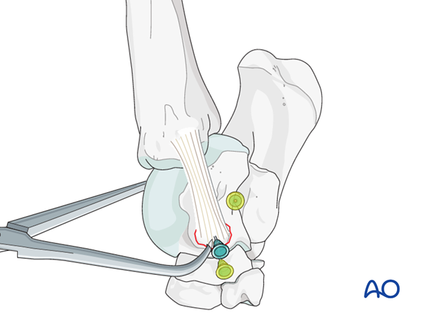 H80_C140_i130 Talus - fractures of the attachment of the collateral ligaments