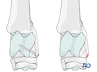 talus collateral ligament attachment