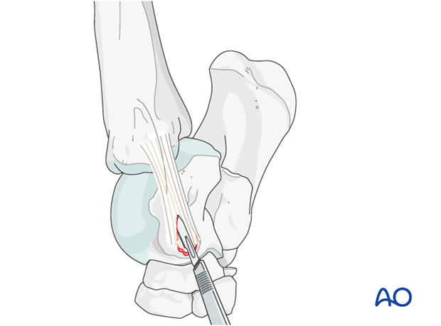 H80_C140_ligament_i200 Talus - fractures of the attachment of the collateral ligaments