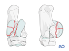Trochlear ridge fractures of the talus - screw fixation