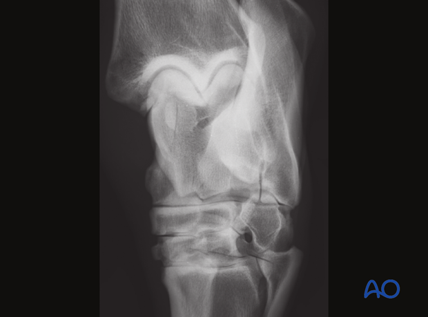H80_C150_x500 Comminuted fractures of the talus