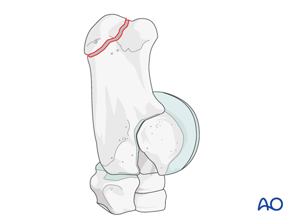 H80_C160_i100 Fractures of the calcaneal shaft